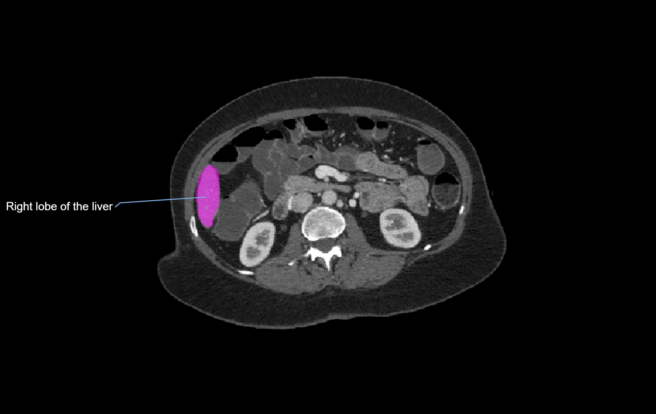 CT lliver lobes axial cross sectional anatomy labelled image -00010.webp